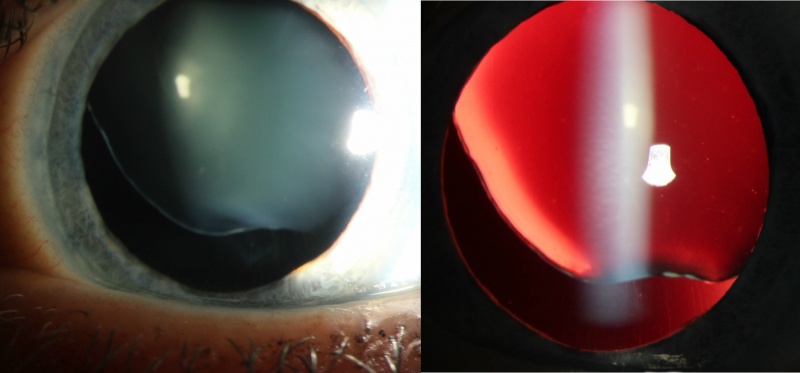 File:Subluxed Lens Combined.jpg