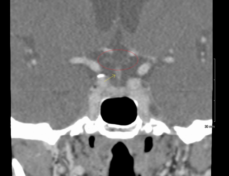 File:Coronal CT sella.jpg