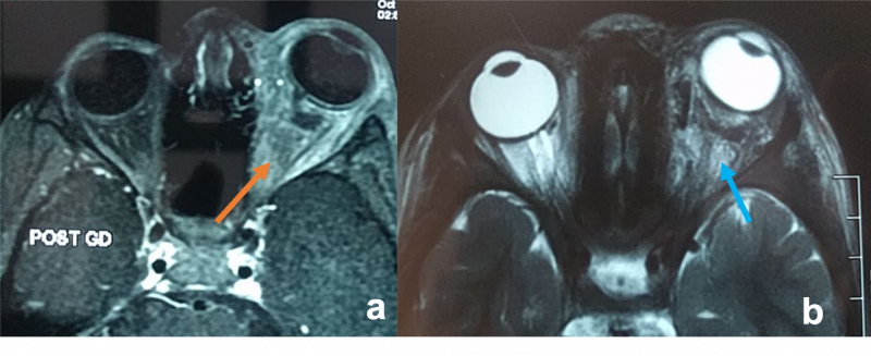File:Rhabdomyosarcoma.png