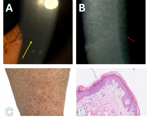 Ocular and Dermatological Findings in X-Linked Ichthyosis (XLI) with Cornea Farinata: A 15-year-old male, presented with recurrent ocular discomfort, photophobia, and difficulty opening his eyes in the morning, alongside chronic dry, scaly skin lesions. (A) Slit-lamp biomicroscopy revealing prominent corneal nerves (yellow arrow), a characteristic finding in X-linked ichthyosis (XLI), often associated with steroid sulfatase deficiency.(B) Higher magnification image highlighting punctate stromal deposits (red arrow), likely due to cholesterol sulfate accumulation. (C) Clinical photograph of the lower limb showing polygonal, adherent dark scales, a hallmark of X-linked ichthyosis.(D) Histopathological section of the skin demonstrating compact orthokeratosis and a preserved granular layer, distinguishing X-linked ichthyosis from ichthyosis vulgaris. Additionally, the patient exhibited cornea farinata, a condition characterized by fine, dust-like stromal opacities. However, these opacities could not be successfully imaged. Cornea farinata is typically asymptomatic and does not affect vision but may be associated with metabolic disorders or systemic conditions such as X-linked ichthy[1] (Courtesy of J. Khadamy)